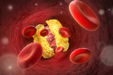 Atherosclerosis-with-RBCs-scaled Atherosclerosis-with-RBCs-scaled